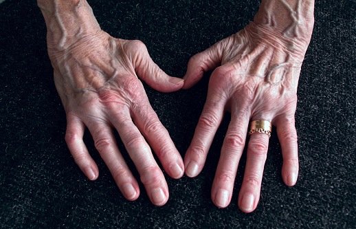 ICD 10 Codes For Rheumatoid Arthritis 