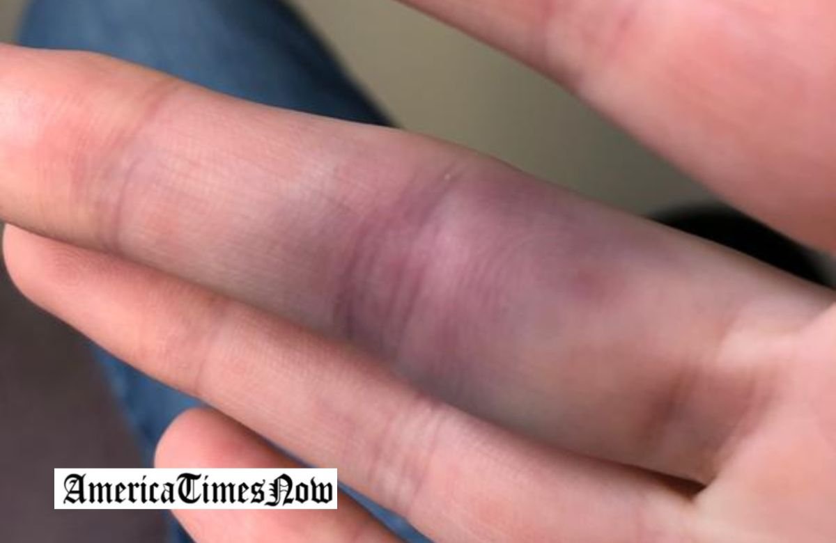 Dealing with a Broken Blood Vessel in Your Finger
